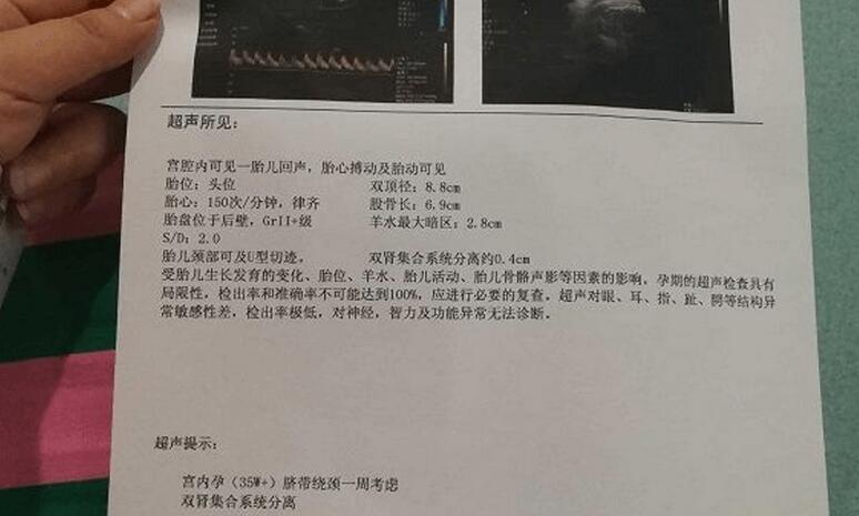 羊水指數(shù)新標(biāo)準(zhǔn)詳解，25cm指南解讀