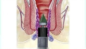 揭秘痔瘡手術(shù)價(jià)格真相，費(fèi)用分析與參考指南