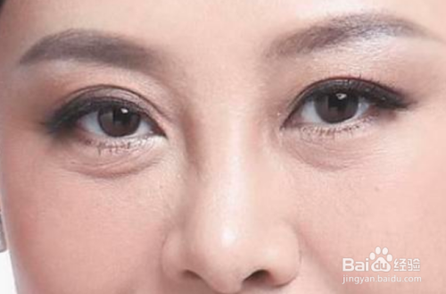 最新去眼袋方法，自信之光重塑雙眸魅力，笑迎變化之旅